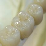 Dental Crown Singleton – Dental Crown Treatment Singleton – MS Dental