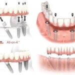 Dental implant cost in Gurgaon