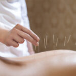 Understanding Acupuncture for Musculoskeletal and Dry Needling Therapy