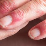 Eczema Triggers Identify tcm for eczema, Eczema Rash Causes