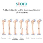 Causes of Fractures – A Quick Guide – Siora Surgicals Pvt. Ltd.