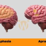 Decoding the Differences: Aphasia and Apraxia Unveiled