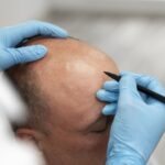 Difference Between FUT Hair Transplant & FUE Hair Transplant