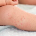 How To Identify Signs Of Infection In Insect Bites