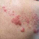 What Are The Early Signs Of Shingles? How Should They Be Treated?