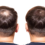 HAIRestart Laser Hair Growth Treatment